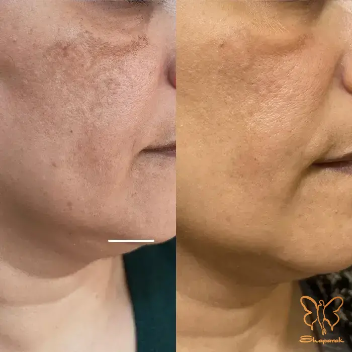  مزو بایواستتیکس روشن ساز در مشهد Meso Bioestetic Whitening