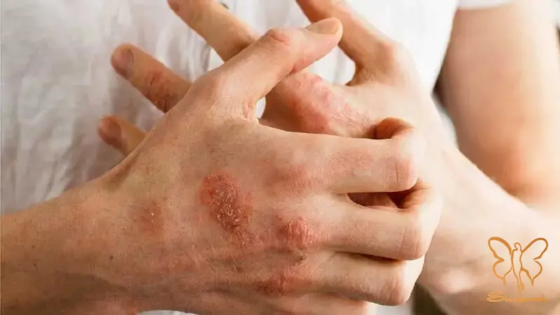 درماتیت تماسی Contact Dermatitis درماتیت تماسی Contact Dermatitis