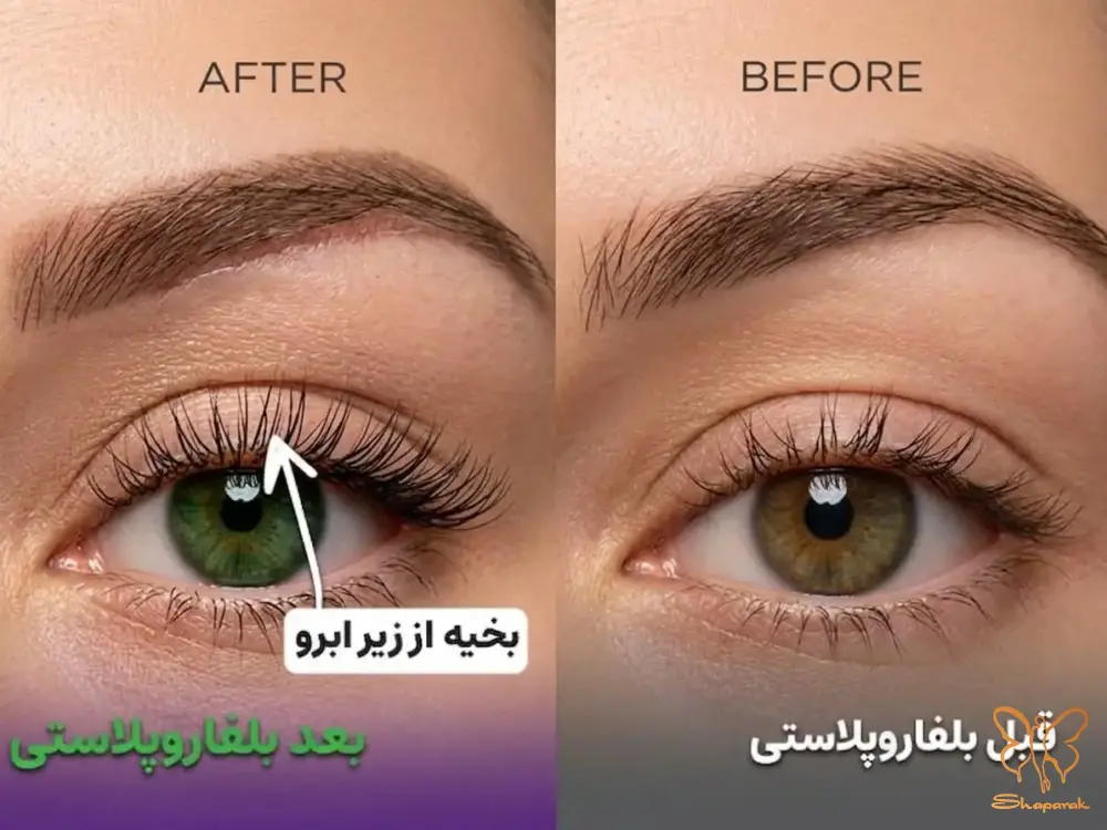 تاثیر بلفاروپلاستی بر زیبایی و بینایی