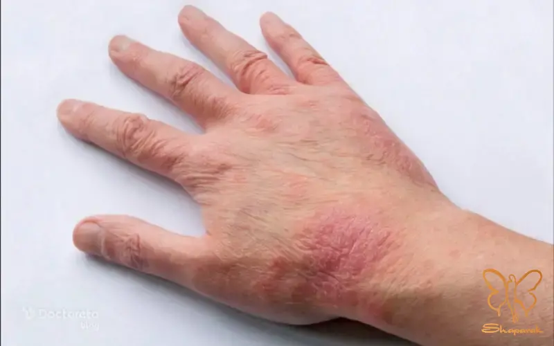 درماتیت آتوپیک Atopic Dermatitis درماتیت آتوپیک Atopic Dermatitis