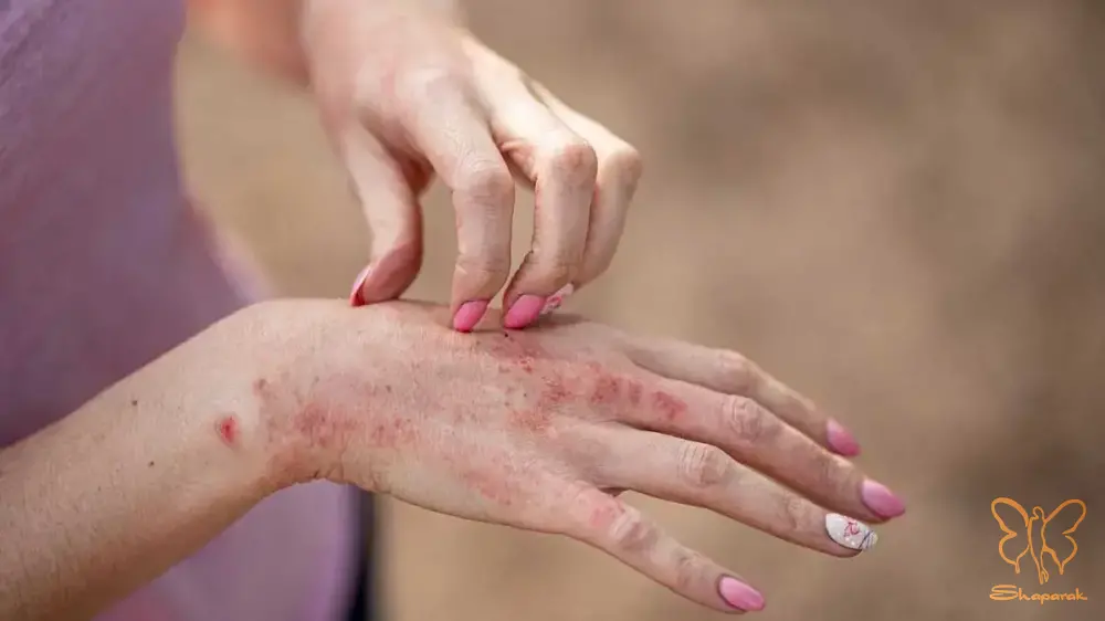 راش پوستی Skin Rash راش پوستی Skin Rash