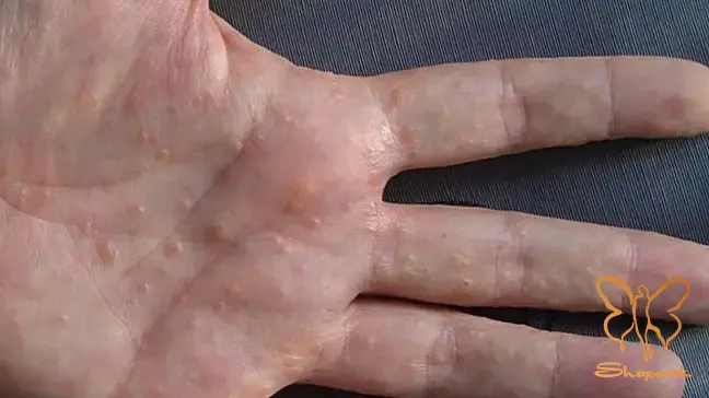 اگزما دیس هیدروتیک Dyshidrotic Eczema اگزما دیس هیدروتیک Dyshidrotic Eczema