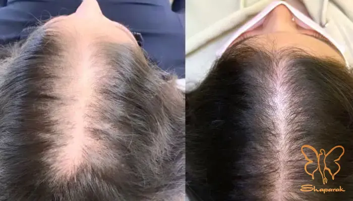 تاثیرات اختصاصی مزو فیوژن بر فولیکول های ضعیف تاثیرات اختصاصی مزو فیوژن بر فولیکول های ضعیف