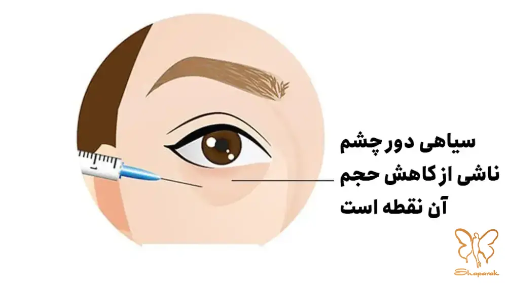 تزریق چربی برای سیاهی دور چشم