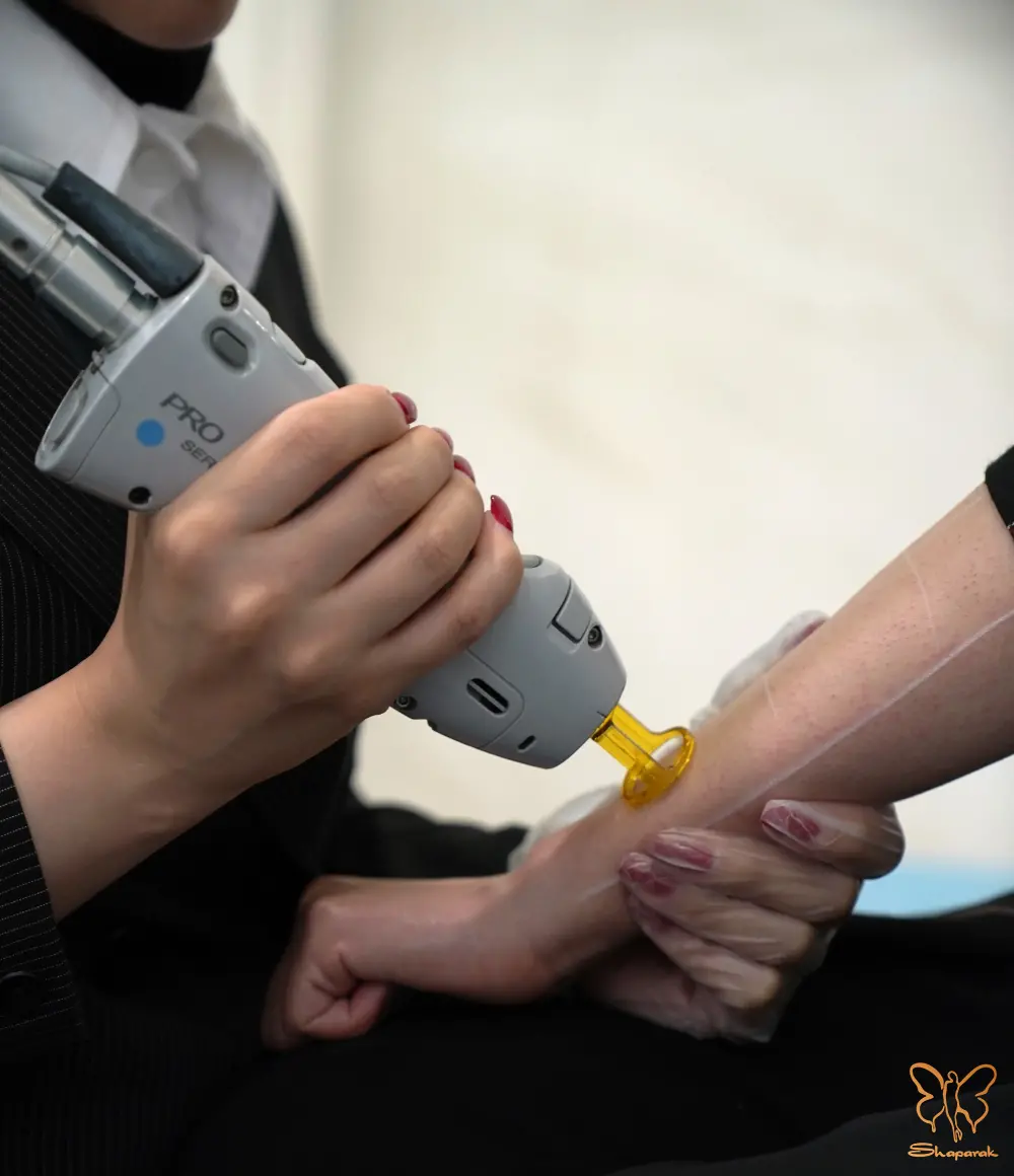 لیزر موهای زائد در مشهد