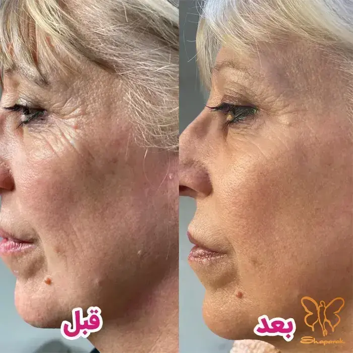 تزریق بوتاکس