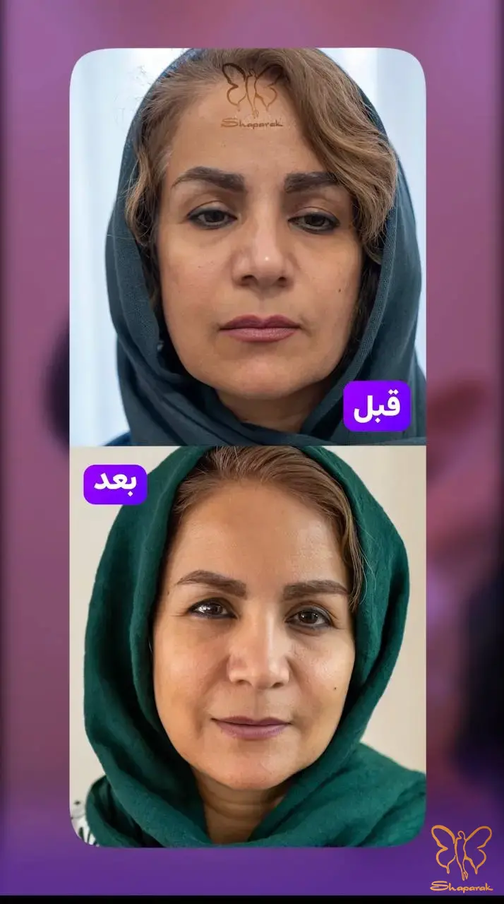 چرا تزریق چربی یک انتخاب هوشمندانه برای جوانسازی است