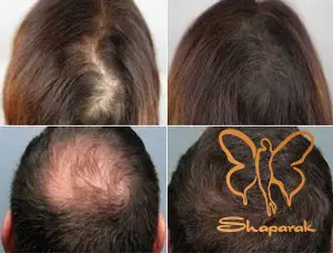 تزریق PRGF در مشهد جوانسازی و توقف ریزش مو تزریق PRGF در مشهد جوانسازی و توقف ریزش مو