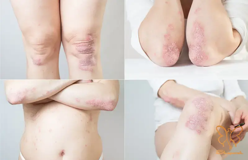 Psoriasisپسوریازیس