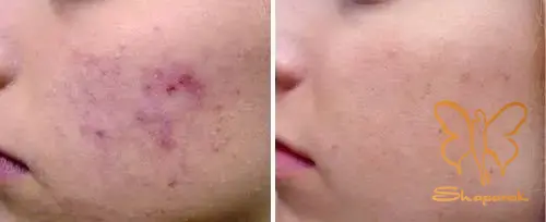  تحریک تولید کلاژن
