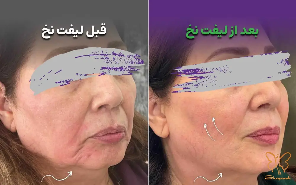 موارد منع استفاده از نخ سیلوئت چه زمانی باید از این روش اجتناب کرد