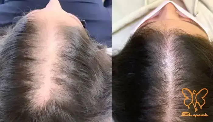  میکرونیدلینگ صورت مشهد