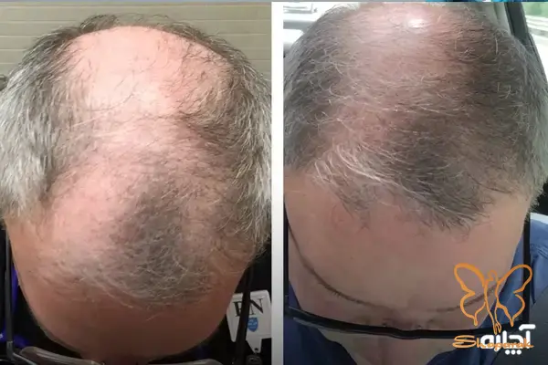 چرا رویتا هیرکیر برای درمان شوره و خشکی مو موثر است چرا رویتا هیرکیر برای درمان شوره و خشکی مو موثر است