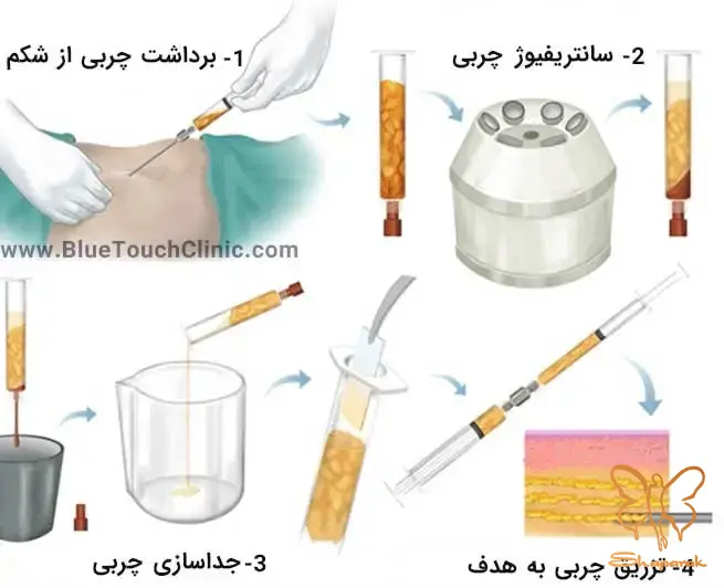 مرحله سوم تزریق Injection