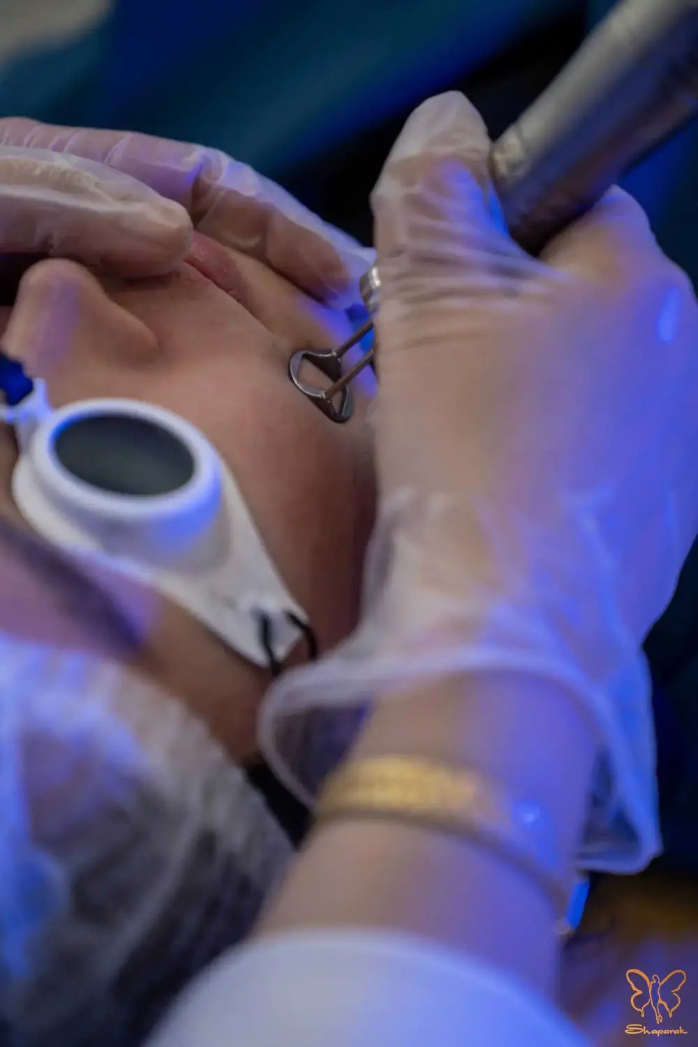 قدرت لیزر فوتونا و درمانهای مکمل در مهار لک هورمونی قدرت لیزر فوتونا و درمانهای مکمل در مهار لک هورمونی