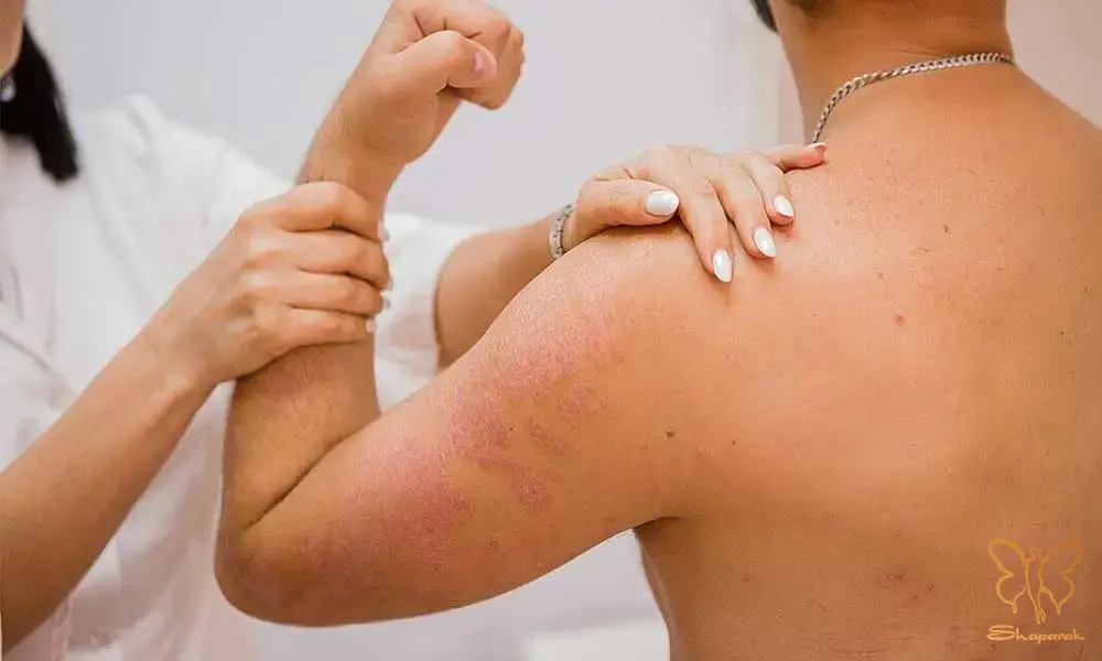 خدمات زیبایی و درمانی Psoriasis پسوریازیس