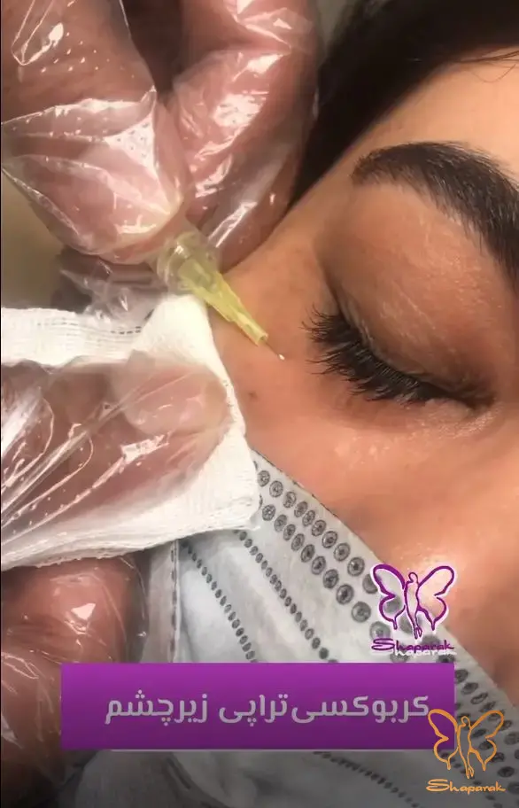 2 تیرگی عروقی Vascular Dark Circles