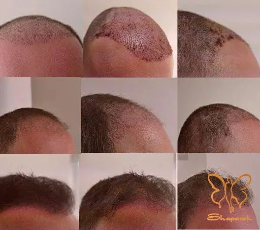 عفونت های فعال پوست سر عفونت های فعال پوست سر