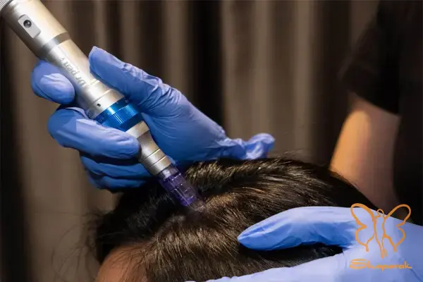 تاریخچه و چگونگی اختراع درمان مزونیدلینگ تاریخچه و چگونگی اختراع درمان مزونیدلینگ