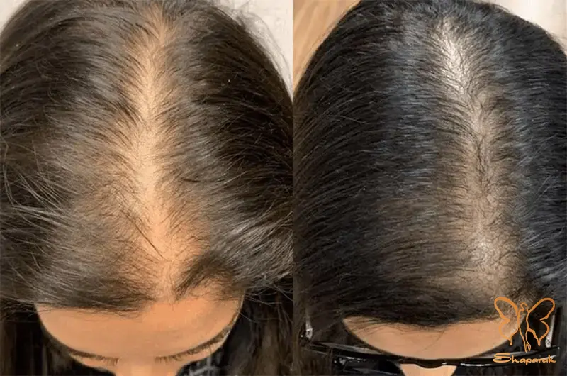 تولید کلاژن و الاستین جدید تولید کلاژن و الاستین جدید