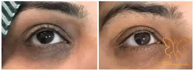 فیبرین غنی از پلاکت خون PRF فیبرین غنی از پلاکت خون PRF