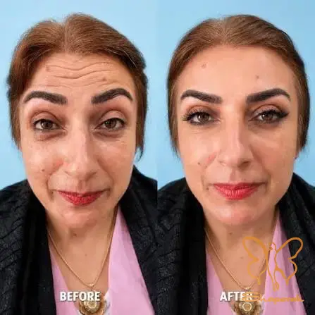 تزریق بوتاکس صورت مشهد تزریق بوتاکس صورت مشهد