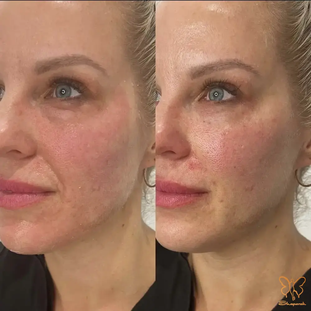 تزریق چربی به همراه PRP صورت تکنیک جوانسازی ماندگار و طبیعی تزریق چربی به همراه PRP صورت تکنیک جوانسازی ماندگار و طبیعی