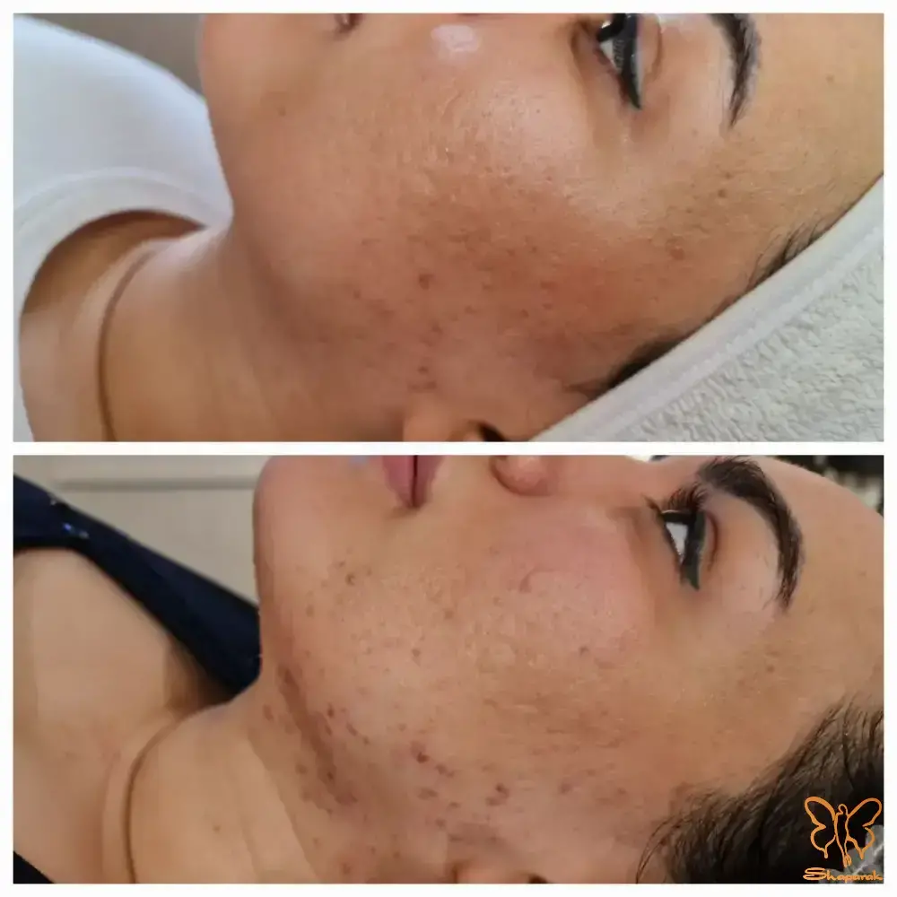 میکرونیدلینگ برای جوانسازی پوست در کلینیک شاپرک مشهد