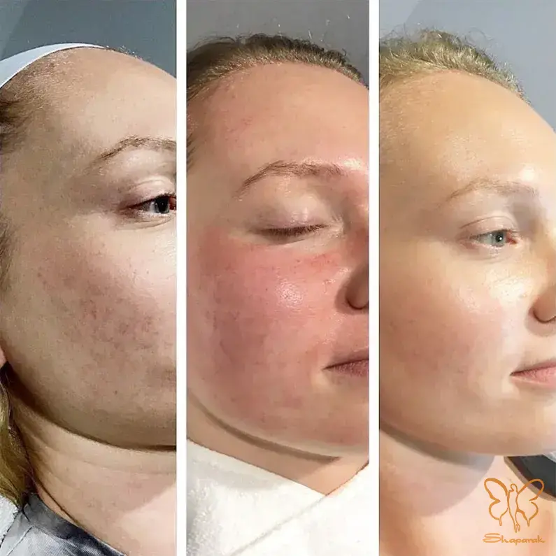 لیزرهای جوانساز مشهد لیزرهای جوانساز مشهد