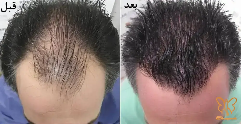 مزوتراپی مو مشهد