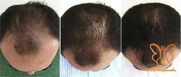  کلاژن و الاستین سازی