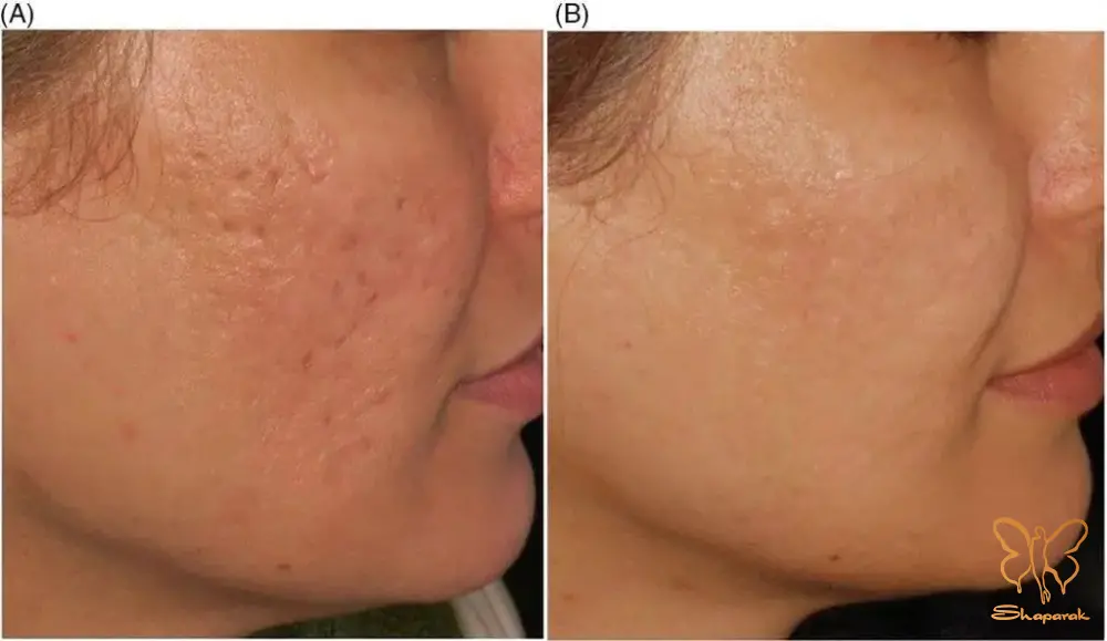 مراقبت از محل ورود کانولا بعد از عمل سابسیژن صورت در مشهد مراقبت از محل ورود کانولا بعد از عمل سابسیژن صورت در مشهد