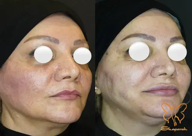 مراقبت های بعد از انجام خدمت زیبایی نخ صورت مراقبت های بعد از انجام خدمت زیبایی نخ صورت