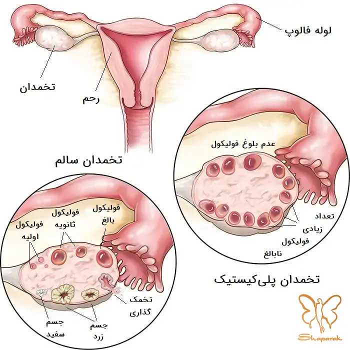 سندروم تخمدان پلی کیستیک یا تنبلی تخمدان PCOS سندروم تخمدان پلی کیستیک یا تنبلی تخمدان PCOS