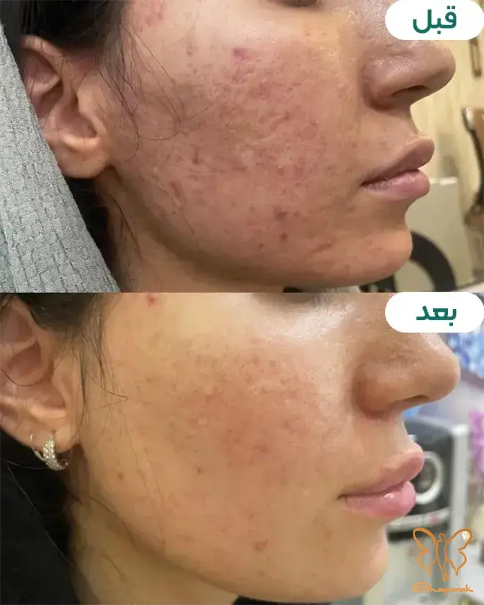 تزریق فیلر