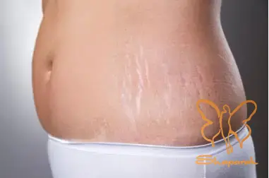مرحله مزمن Striae Albae