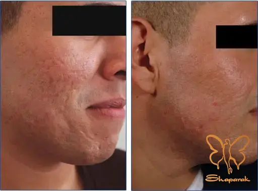 دستگاه فوتونا فرکشنال صورت مشهد دستگاه فوتونا فرکشنال صورت مشهد