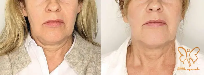 توصیه های نهایی برای انجام خدمات زیبایی در کلینیک شاپرک طلایی