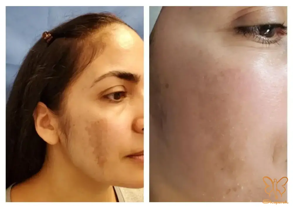 مزوتراپی صورت و مو در مشهد مزوتراپی صورت و مو در مشهد