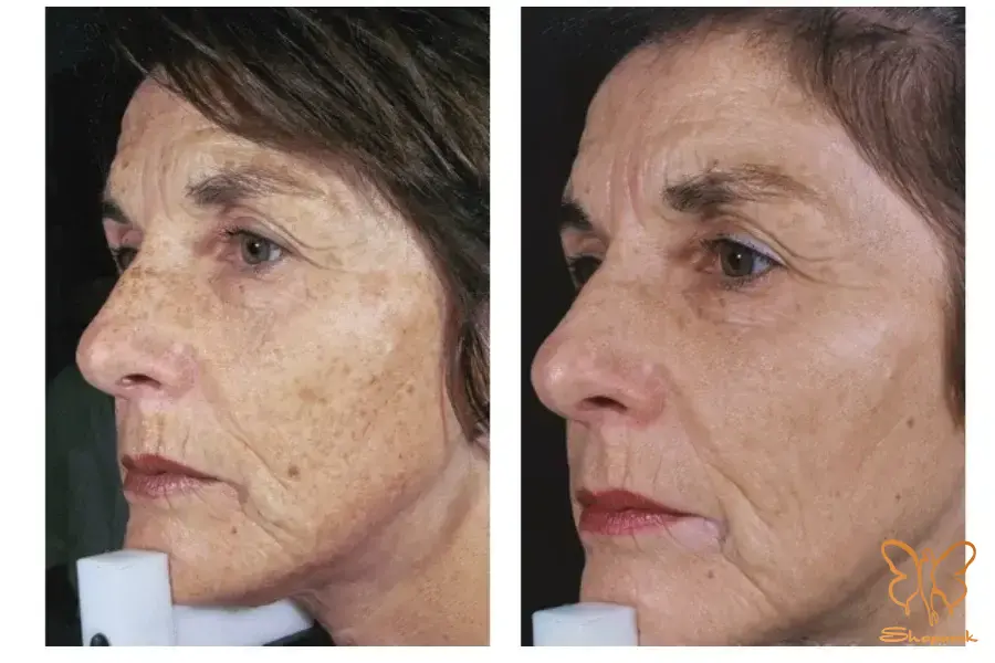 کلینیک تخصصی لیزر موهای زائد شاپرک طلایی مشهد