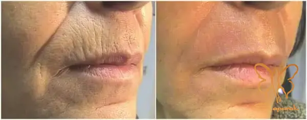 میکرونیدلینگ صورت در مشهد