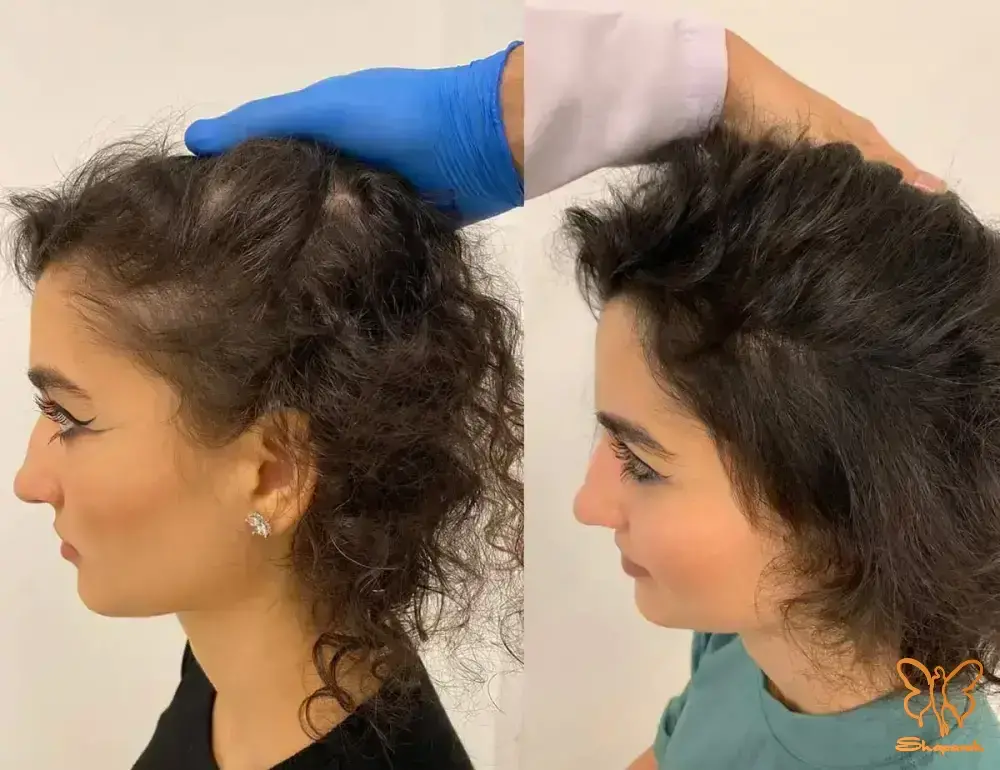 &nbsp;کاهش لکه های پوستی&nbsp;