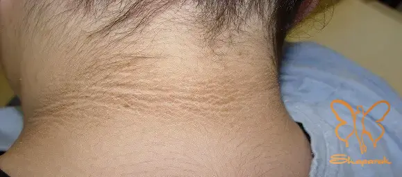 علائم و نشانههای کلیدی برای شناسایی قارچ پوستی علائم و نشانههای کلیدی برای شناسایی قارچ پوستی