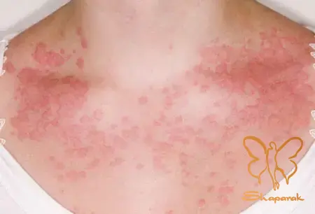 تشخیص قطعی لک های پوستی در مشهد تشخیص قطعی لک های پوستی در مشهد