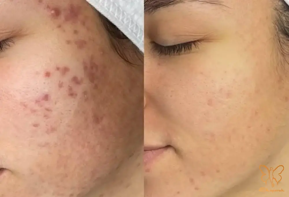 لیزر فوتونا در مشهد لیزر فوتونا در مشهد