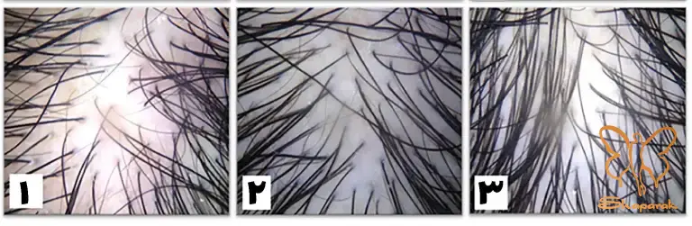 مکانیزم اثر کربوکسی تراپی در جذب آهن مکانیزم اثر کربوکسی تراپی در جذب آهن