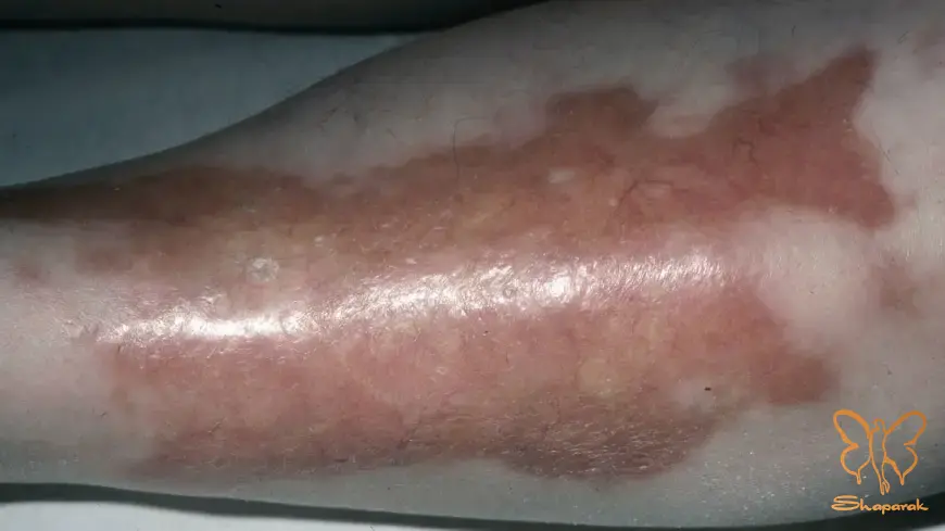 آیا نکروبیوز لیپویدیکا مسری ویروسی یا ژنتیکی است آیا نکروبیوز لیپویدیکا مسری ویروسی یا ژنتیکی است