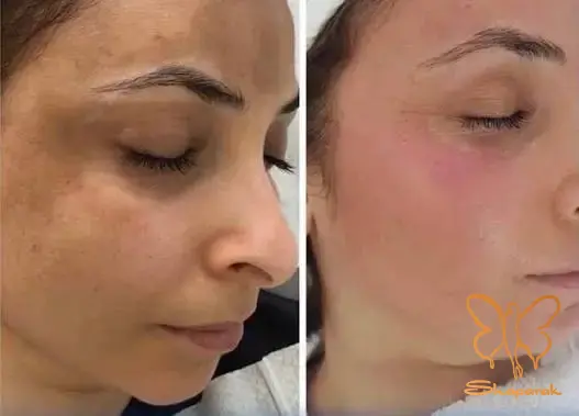 فوتونا فرکشنال صورت مشهد