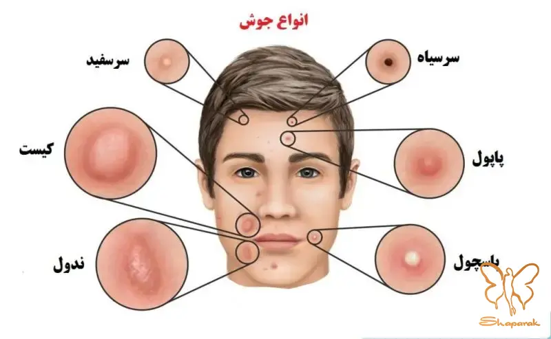 عوامل درونی جوش در آقایان قدرتنمایی آندروژنها و ژنتیک