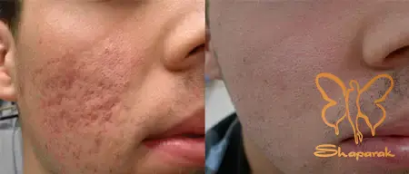 میکرونیدلینگ صورت با PRP&nbsp;